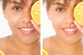Before after close up african american woman face with acne and problem skin. Beauty skin care treatment. Before-after Facial
