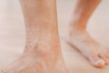 Close up allergic rash dermatitis eczema on man foot. Leg with red rash caused by insect bites. Dermatitis, folliculitis Royalty Free Stock Photo