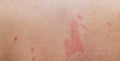 Close up Allergy rash, Around Back view of human with dermatitis problem of rash ,Allergy rash and Health problem. Royalty Free Stock Photo