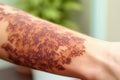 close-up of allergy skin patch test on arm