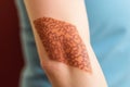 close-up of allergy skin patch test on arm