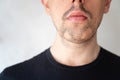 Close up of alopecia areata on a man`s beard Royalty Free Stock Photo