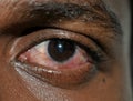 Red eyes. Indian guy. Close up of annoyed red eyes of male affected by conjunctivitis or after flu, cold or allergy.