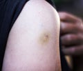 Asia woman`s shoulder with bruises from rabies vaccination