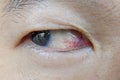 Close-up Asian man eye with eye irritation