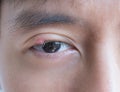 Close up of Asian young man with brown eye with stye infection. Eyelid abscess, hordeolum in medical health, disease and treatment Royalty Free Stock Photo