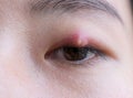 Close up of Asian young woman with brown eye with stye infection. Eyelid abscess, hordeolum in medical health, disease and Royalty Free Stock Photo
