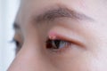 Close up of Asian young woman with brown eye with stye infection. Eyelid abscess, hordeolum in medical health, disease and Royalty Free Stock Photo