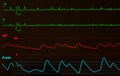 Close Up of Atrial Flutter on Monitor with Black Screen