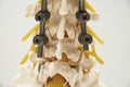 Model of instrument fixation of human lumbar spine model