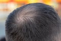 Close-up of a bald spot on a man's head. Royalty Free Stock Photo