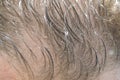 Close-up balding head of a young man Royalty Free Stock Photo