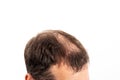 Close-up balding head of a young man on a white isolated background Royalty Free Stock Photo