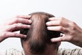 Close-up balding head of a young man on a white isolated background Royalty Free Stock Photo