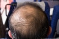 Close-up of balding and thinning hair of man revealing scalp Royalty Free Stock Photo