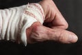 A close-up of a bandaged hand displaying remnants of a second-degree burn on the knuckle of the thumb