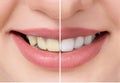 Close up beautiful teeth before and after whitening or bleaching, health dental care beauty clinic concept. Royalty Free Stock Photo