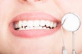 Close-up of beautiful white teeth with dentist tools Royalty Free Stock Photo