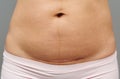 close up belly of woman with c-section scar of caesarean Royalty Free Stock Photo