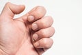 Close- up of bitten and brittle nails. A broken nail on your finger Royalty Free Stock Photo