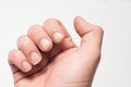 Close- up of bitten and brittle nails. A broken nail on your finger