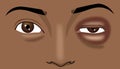 Close-up the black man\'s red eye is swollen, illustration drawing