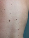 Close up skin problem `Melanoma` the black spot on human back skin.