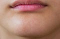 Close up blackhead pimpels on the chin of teenage boy. Skin care acne problem in teenager