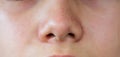 Close up blackhead pimpels on the nose of teenage boy. Skin care  acne problem in teenager Royalty Free Stock Photo