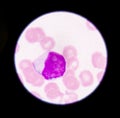 Blast cells in blood smear