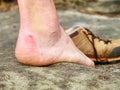 Close up on Blister on foot of a male. Hurt hikers legs without shoes.