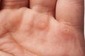 Close-up of blister on human hand