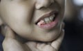 Close-up of boy mouth biting the gauze in mouth after tooth extraction at the clinic,concept of examining the brink and keeping Royalty Free Stock Photo