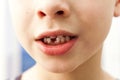 Close-up of boy smiling with missing front milk tooth over light Royalty Free Stock Photo
