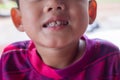 Close up boy smiling tooth caries. the concept of dental and oral health of children and toothpaste