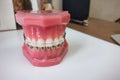 Dental braces model Royalty Free Stock Photo