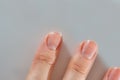 Close-up of brittle nails on woman& x27;s hands. Female broken fingernail. Royalty Free Stock Photo