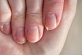 Close-up of brittle nails on woman& x27;s hands. Female broken fingernail. Royalty Free Stock Photo