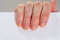 Close-up of brittle nails on woman& x27;s hands. Female broken fingernail. Royalty Free Stock Photo