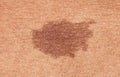 Close-up of brown birthmark