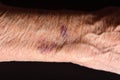 Close up of a bruise in the arm of senior woman