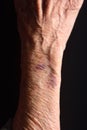 Close up of a bruise in the arm of senior woman