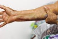 Close up bruise wounded skin texture of old asian woman right arm