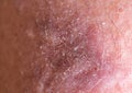 Close-up of bumpy skin with blemishes and scaly epidermis, dermatology and skin diseases Royalty Free Stock Photo