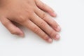 Close up child`s fingers with dry skin, Eczema Dermatitis. Royalty Free Stock Photo