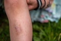 Close-up of a child's leg with a bruise after falling off a bicycle