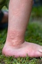 Close-up of a child's leg with stinging nettle blisters