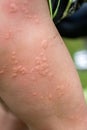 Close-up of a child's leg with stinging nettle blisters