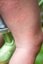 Close-up of a child's leg with stinging nettle blisters