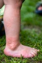 Close-up of a child's leg with stinging nettle blisters